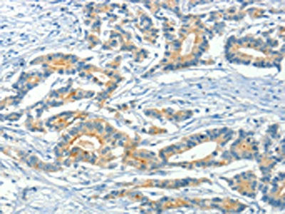 The image on the left is immunohistochemistry of paraffin-embedded Human colon cancer tissue using ASAH2 Antibody(ASAH2 Antibody) at dilution 1/50, on the right is treated with fusion protein. (Original magnification: ×200)Rabbit anti-Human ASAH2 Polyclonal Antibody