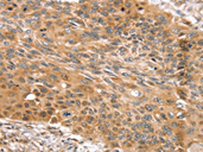 The image on the left is immunohistochemistry of paraffin-embedded Human esophagus cancer tissue using SNX11 Antibody(SNX11 Antibody) at dilution 1/30, on the right is treated with fusion protein. (Original magnification: ×200)Rabbit anti-Human SNX11 Polyclonal Antibody
