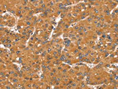 The image on the left is immunohistochemistry of paraffin-embedded Human liver cancer tissue using the antibody Antibody) at dilution 1/30, on the right is treated with fusion protein. (Original magnification: ×200)Rabbit anti-Human SNX11 Polyclonal Antibody