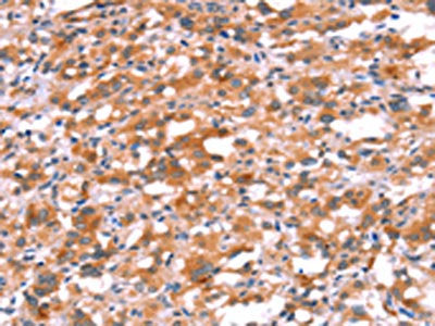 The image on the left is immunohistochemistry of paraffin-embedded Human thyroid cancer tissue using BCAR1 Antibody(BCAR1 Antibody) at dilution 1/15, on the right is treated with synthetic peptide. (Original magnification: ×200)