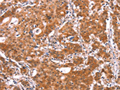 The image on the left is immunohistochemistry of paraffin-embedded Human gastic cancer tissue using the antibody Antibody) at dilution 1/15, on the right is treated with synthetic peptide. (Original magnification: ×200)