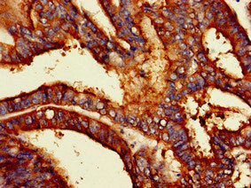 Immunohistochemistry of paraffin-embedded human endometrial cancer using PODXL Antibody at dilution of 1:100Rabbit anti-Human PODXL Polyclonal Antibody