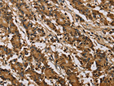 The image on the left is immunohistochemistry of paraffin-embedded Human colon cancer tissue using PSMC2 Antibody(PSMC2 Antibody) at dilution 1/30, on the right is treated with fusion protein. (Original magnification: ×200)Rabbit anti-Human PSMC2 Polyclonal Antibody