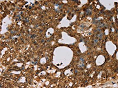The image on the left is immunohistochemistry of paraffin-embedded Human cervical cancer tissue using the antibody Antibody) at dilution 1/30, on the right is treated with fusion protein. (Original magnification: ×200)Rabbit anti-Human PSMC2 Polyclonal Antibody