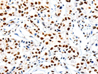 The image on the left is immunohistochemistry of paraffin-embedded Human lung cancer tissue using HDAC1 Antibody(HDAC1 Antibody) at dilution 1/20, on the right is treated with synthetic peptide. (Original magnification: ×200)Rabbit anti-Human HDAC1 Polyclonal Antibody