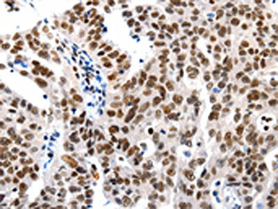 The image on the left is immunohistochemistry of paraffin-embedded Human ovarian cancer tissue using the antibody Antibody) at dilution 1/20, on the right is treated with synthetic peptide. (Original magnification: ×200)Rabbit anti-Human HDAC1 Polyclonal Antibody