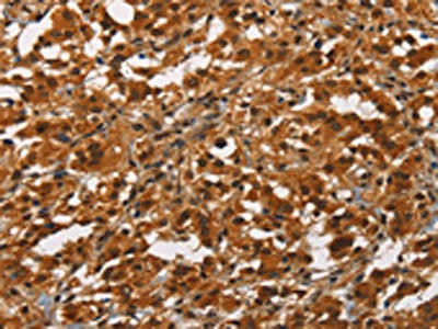 The image on the left is immunohistochemistry of paraffin-embedded Human thyroid cancer tissue using the antibody Antibody) at dilution 1/50, on the right is treated with synthetic peptide. (Original magnification: ×200)Rabbit anti-Human ANAPC4 Polyclonal Antibody
