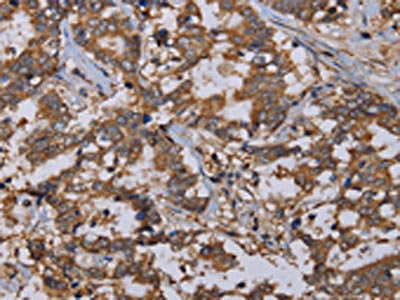 The image on the left is immunohistochemistry of paraffin-embedded Human liver cancer tissue using REG3G Antibody(REG3G Antibody) at dilution 1/40, on the right is treated with fusion protein. (Original magnification: ×200)Rabbit anti-Human REG3G Polyclonal Antibody