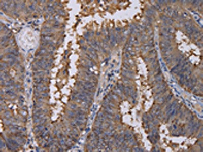 The image on the left is immunohistochemistry of paraffin-embedded Human colon cancer tissue using the antibody Antibody) at dilution 1/40, on the right is treated with fusion protein. (Original magnification: ×200)Rabbit anti-Human REG3G Polyclonal Antibody