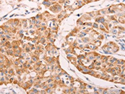 The image on the left is immunohistochemistry of paraffin-embedded Human lung cancer tissue using GNA11 Antibody(GNA11 Antibody) at dilution 1/40, on the right is treated with fusion protein. (Original magnification: ×200)Rabbit anti-Human GNA11 Polyclonal Antibody