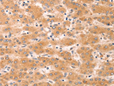 The image on the left is immunohistochemistry of paraffin-embedded Human liver cancer tissue using the antibody Antibody) at dilution 1/40, on the right is treated with fusion protein. (Original magnification: ×200)Rabbit anti-Human GNA11 Polyclonal Antibody