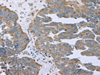 The image on the left is immunohistochemistry of paraffin-embedded Human ovarian cancer tissue using ESR2 Antibody(ESR2 Antibody) at dilution 1/30, on the right is treated with fusion protein. (Original magnification: ×200)Rabbit anti-Human ESR2 Polyclonal Antibody