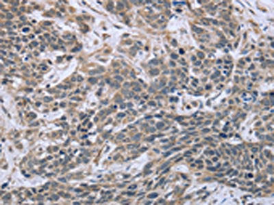 The image on the left is immunohistochemistry of paraffin-embedded Human cervical cancer tissue using the antibody Antibody) at dilution 1/30, on the right is treated with fusion protein. (Original magnification: ×200)Rabbit anti-Human ESR2 Polyclonal Antibody