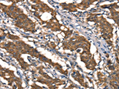 The image on the left is immunohistochemistry of paraffin-embedded Human gastric cancer tissue using DAAM1 Antibody(DAAM1 Antibody) at dilution 1/40, on the right is treated with synthetic peptide. (Original magnification: ×200)