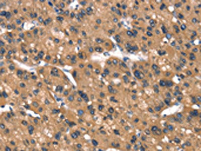The image on the left is immunohistochemistry of paraffin-embedded Human liver cancer tissue using the antibody Antibody) at dilution 1/40, on the right is treated with synthetic peptide. (Original magnification: ×200)