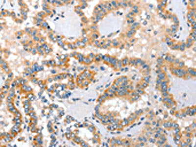 The image on the left is immunohistochemistry of paraffin-embedded Human thyroid cancer tissue using ALPP Antibody(ALPP Antibody) at dilution 1/60, on the right is treated with fusion protein. (Original magnification: ×200)Rabbit anti-Human ALPP Polyclonal Antibody