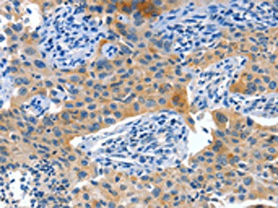 The image on the left is immunohistochemistry of paraffin-embedded Human lung cancer tissue using the antibody Antibody) at dilution 1/60, on the right is treated with fusion protein. (Original magnification: ×200)Rabbit anti-Human ALPP Polyclonal Antibody