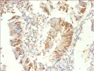 Immunohistochemistry of paraffin-embedded human colon cancer using the antibody at dilution of 1:100Rabbit anti-Human PSME3 Polyclonal Antibody