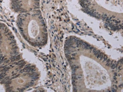 The image on the left is immunohistochemistry of paraffin-embedded Human colon cancer tissue using HIST1H2AH Antibody(HIST1H2AH Antibody) at dilution 1/40, on the right is treated with fusion protein. (Original magnification: ×200)Rabbit anti-Human HIST1H2AH Polyclonal Antibody