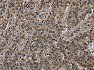 The image on the left is immunohistochemistry of paraffin-embedded Human liver cancer tissue using the antibody Antibody) at dilution 1/40, on the right is treated with fusion protein. (Original magnification: ×200)Rabbit anti-Human HIST1H2AH Polyclonal Antibody