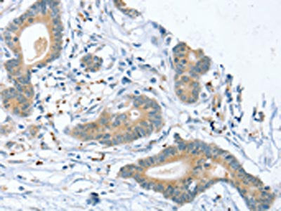 The image on the left is immunohistochemistry of paraffin-embedded Human colon cancer tissue using SLIT2 Antibody(SLIT2 Antibody) at dilution 1/30, on the right is treated with synthetic peptide. (Original magnification: ×200)Rabbit anti-Human SLIT2 Polyclonal Antibody