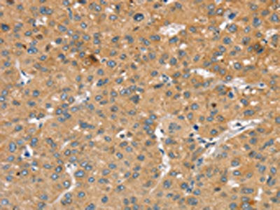 The image on the left is immunohistochemistry of paraffin-embedded Human liver cancer tissue using the antibody Antibody) at dilution 1/30, on the right is treated with synthetic peptide. (Original magnification: ×200)Rabbit anti-Human SLIT2 Polyclonal Antibody