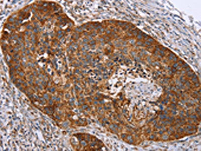 The image on the left is immunohistochemistry of paraffin-embedded Human esophagus cancer tissue using RMDN3 Antibody(RMDN3 Antibody) at dilution 1/20, on the right is treated with fusion protein. (Original magnification: ×200)Rabbit anti-Human RMDN3 Polyclonal Antibody