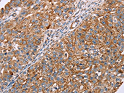 The image on the left is immunohistochemistry of paraffin-embedded Human breast cancer tissue using the antibody Antibody) at dilution 1/20, on the right is treated with fusion protein. (Original magnification: ×200)Rabbit anti-Human RMDN3 Polyclonal Antibody