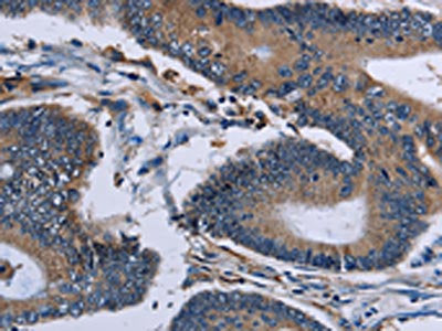 The image on the left is immunohistochemistry of paraffin-embedded Human colon cancer tissue using IPO4 Antibody(IPO4 Antibody) at dilution 1/50, on the right is treated with fusion protein. (Original magnification: ×200)