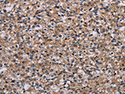 The image on the left is immunohistochemistry of paraffin-embedded Human prostate cancer tissue using the antibody Antibody) at dilution 1/50, on the right is treated with fusion protein. (Original magnification: ×200)