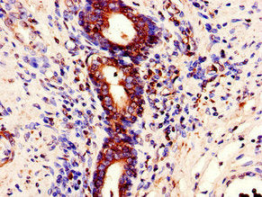 Immunohistochemistry of paraffin-embedded human prostate cancer using STAU1 Antibody at dilution of 1:100Rabbit anti-Human STAU1 Polyclonal Antibody