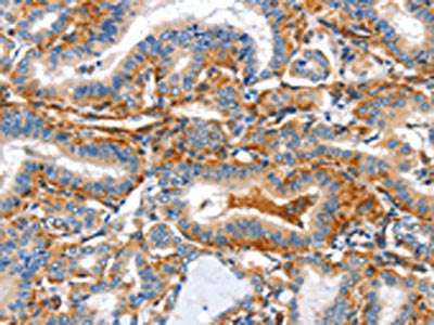 The image on the left is immunohistochemistry of paraffin-embedded Human thyroid cancer tissue using AIFM3 Antibody(AIFM3 Antibody) at dilution 1/50, on the right is treated with fusion protein. (Original magnification: ×200)Rabbit anti-Human AIFM3 Polyclonal Antibody