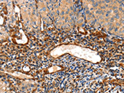 The image on the left is immunohistochemistry of paraffin-embedded Human cervical cancer tissue using the antibody Antibody) at dilution 1/50, on the right is treated with fusion protein. (Original magnification: ×200)Rabbit anti-Human AIFM3 Polyclonal Antibody