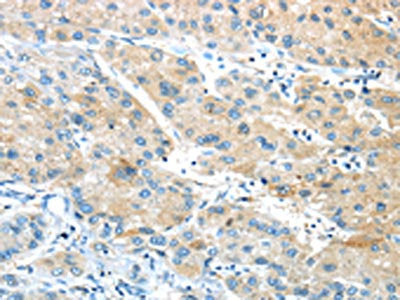 The image on the left is immunohistochemistry of paraffin-embedded Human liver cancer tissue using GPR15 Antibody(GPR15 Antibody) at dilution 1/20, on the right is treated with synthetic peptide. (Original magnification: ×200)