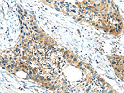 The image on the left is immunohistochemistry of paraffin-embedded Human esophagus cancer tissue using the antibody Antibody) at dilution 1/20, on the right is treated with synthetic peptide. (Original magnification: ×200)