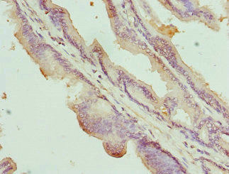 Immunohistochemistry of paraffin-embedded human prostate cancer using the antibody at dilution of 1:100Rabbit anti-Human NOX5 Polyclonal Antibody
