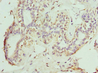 Immunohistochemistry of paraffin-embedded human breast cancer using NOX5 Antibody at dilution of 1:100Rabbit anti-Human NOX5 Polyclonal Antibody