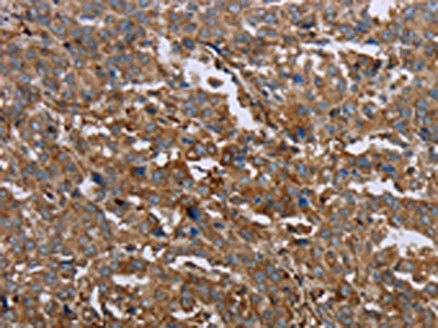 The image on the left is immunohistochemistry of paraffin-embedded Human liver cancer tissue using GCK Antibody(GCK Antibody) at dilution 1/40, on the right is treated with fusion protein. (Original magnification: ×200)Rabbit anti-Human GCK Polyclonal Antibody
