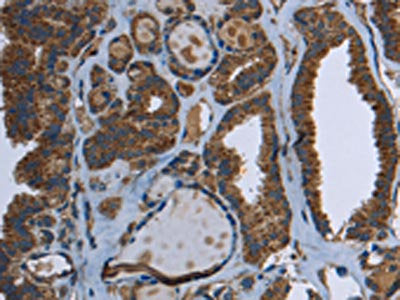The image on the left is immunohistochemistry of paraffin-embedded Human thyroid cancer tissue using the antibody Antibody) at dilution 1/40, on the right is treated with fusion protein. (Original magnification: ×200)Rabbit anti-Human GCK Polyclonal Antibody