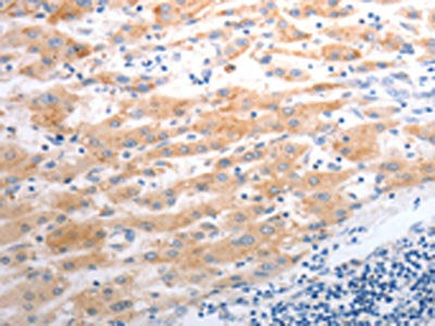 The image on the left is immunohistochemistry of paraffin-embedded Human liver cancer tissue using SLC22A6 Antibody(SLC22A6 Antibody) at dilution 1/40, on the right is treated with synthetic peptide. (Original magnification: ×200)Rabbit anti-Human SLC22A6 Polyclonal Antibody