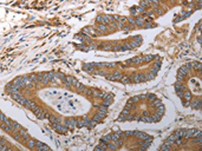 The image on the left is immunohistochemistry of paraffin-embedded Human colon cancer tissue using the antibody Antibody) at dilution 1/40, on the right is treated with synthetic peptide. (Original magnification: ×200)Rabbit anti-Human SLC22A6 Polyclonal Antibody