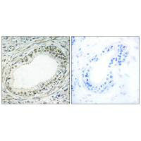 Immunohistochemistry analysis of paraffin-embedded human prostate carcinoma tissue using RPL36 antibody.Rabbit anti-Human RPL36 Polyclonal Antibody