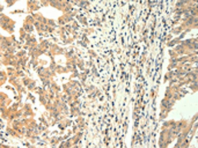The image on the left is immunohistochemistry of paraffin-embedded Human gastric cancer tissue using TRPM5 Antibody(TRPM5 Antibody) at dilution 1/60, on the right is treated with synthetic peptide. (Original magnification: ×200)Rabbit anti-Human TRPM5 Polyclonal Antibody