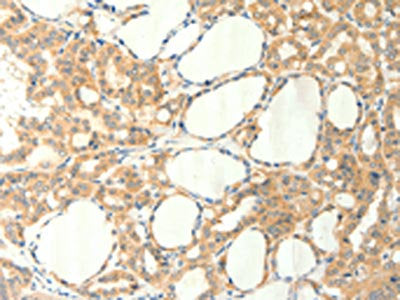 The image on the left is immunohistochemistry of paraffin-embedded Human thyroid cancer tissue using the antibody Antibody) at dilution 1/60, on the right is treated with synthetic peptide. (Original magnification: ×200)Rabbit anti-Human TRPM5 Polyclonal Antibody
