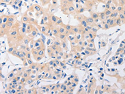 The image on the left is immunohistochemistry of paraffin-embedded Human lung cancer tissue using P2RY11 Antibody(P2RY11 Antibody) at dilution 1/30, on the right is treated with synthetic peptide. (Original magnification: ×200)Rabbit anti-Human P2RY11 Polyclonal Antibody