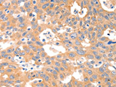 The image on the left is immunohistochemistry of paraffin-embedded Human ovarian cancer tissue using the antibody Antibody) at dilution 1/30, on the right is treated with synthetic peptide. (Original magnification: ×200)Rabbit anti-Human P2RY11 Polyclonal Antibody