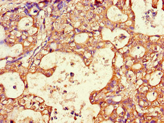 Immunohistochemistry of paraffin-embedded human gastric cancer using AQP3 Antibody at dilution of 1:100Rabbit anti-Human AQP3 Polyclonal Antibody