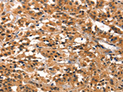 The image on the left is immunohistochemistry of paraffin-embedded Human thyroid cancer tissue using PRKD1 Antibody(PRKD1 Antibody) at dilution 1/15, on the right is treated with synthetic peptide. (Original magnification: ×200)Rabbit anti-Human PRKD1 Polyclonal Antibody