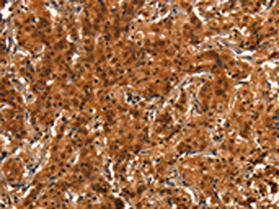 The image on the left is immunohistochemistry of paraffin-embedded Human gastic cancer tissue using the antibody Antibody) at dilution 1/15, on the right is treated with synthetic peptide. (Original magnification: ×200)Rabbit anti-Human PRKD1 Polyclonal Antibody