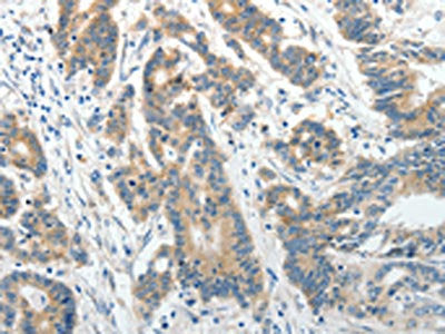 The image on the left is immunohistochemistry of paraffin-embedded Human colon cancer tissue using ABCG1 Antibody(ABCG1 Antibody) at dilution 1/25, on the right is treated with synthetic peptide. (Original magnification: ×200)